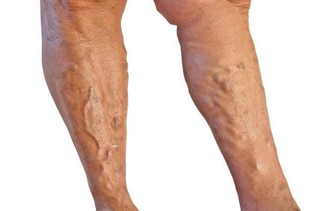 Gyógyítható-e a lábak visszér?